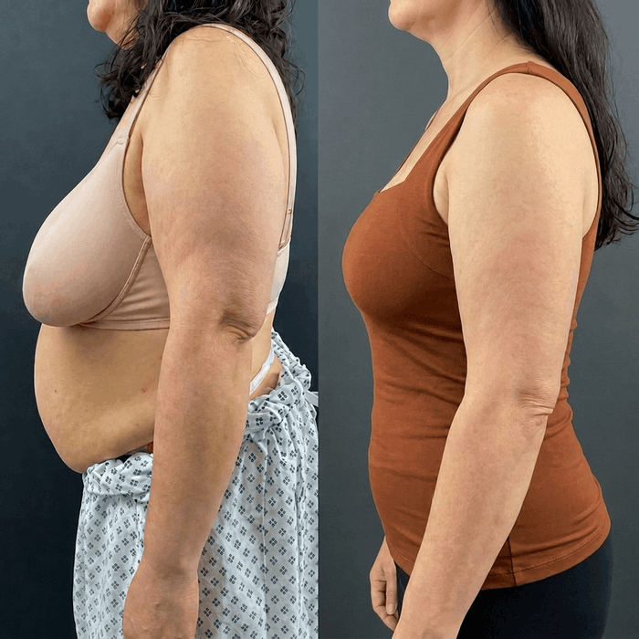 Cynthia W. before and after wearing the built-in bra tank